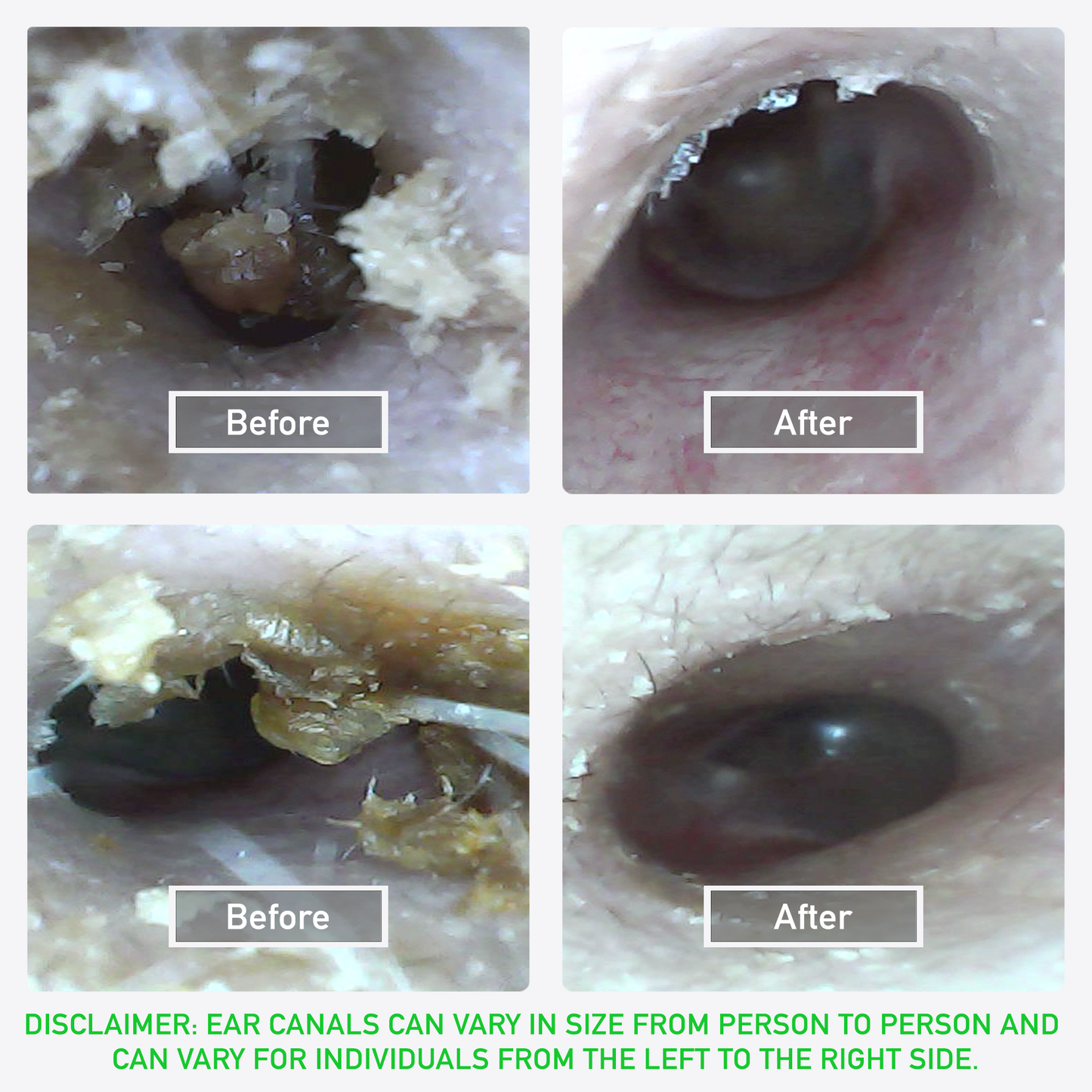 OXORA EarScope™ Ear Cleaner